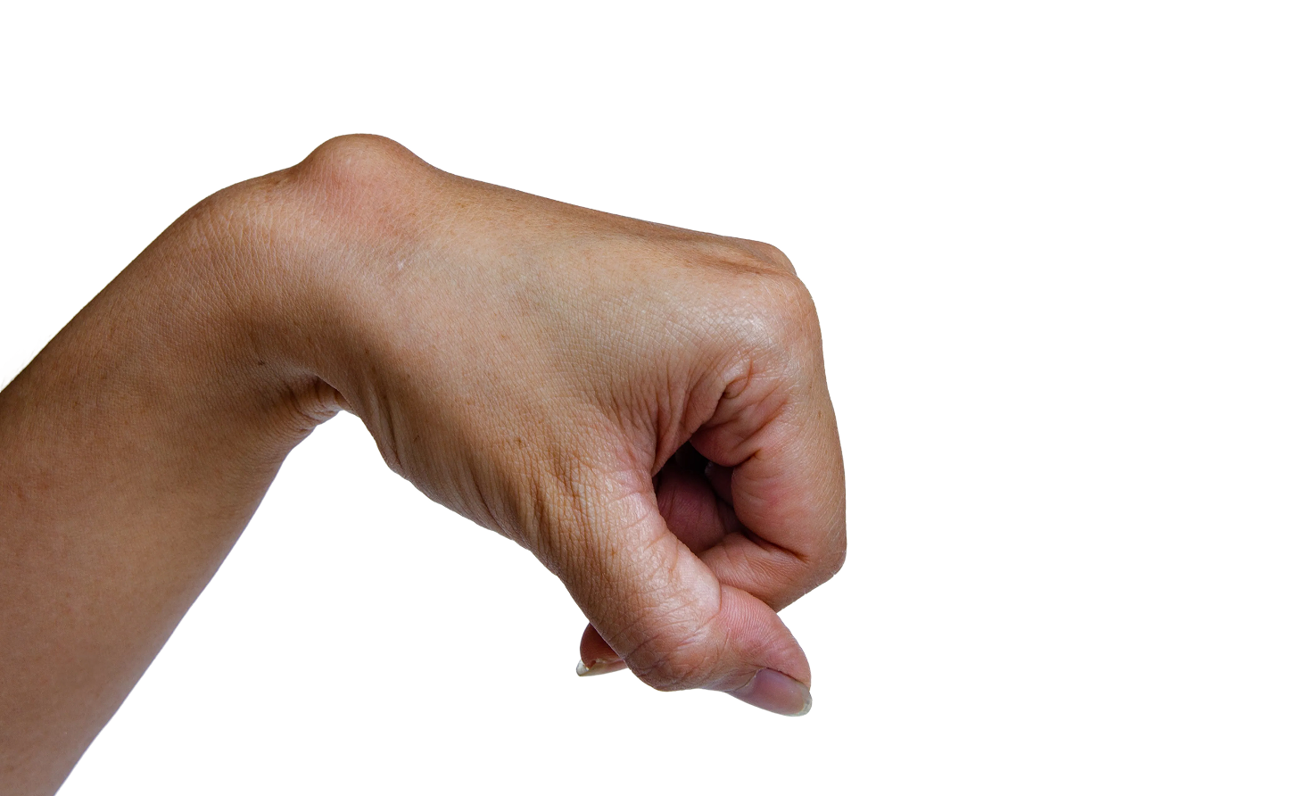 Ganglion Überbein München – Punktion
