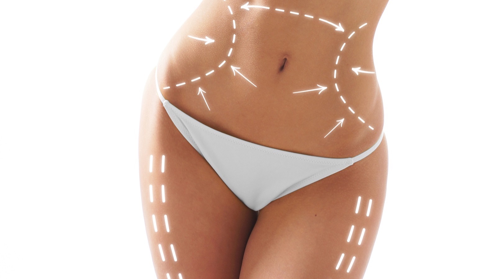 Klassische Liposuktion – Fettabsaugung mit OP-Markierung, Dr. Heitland München
