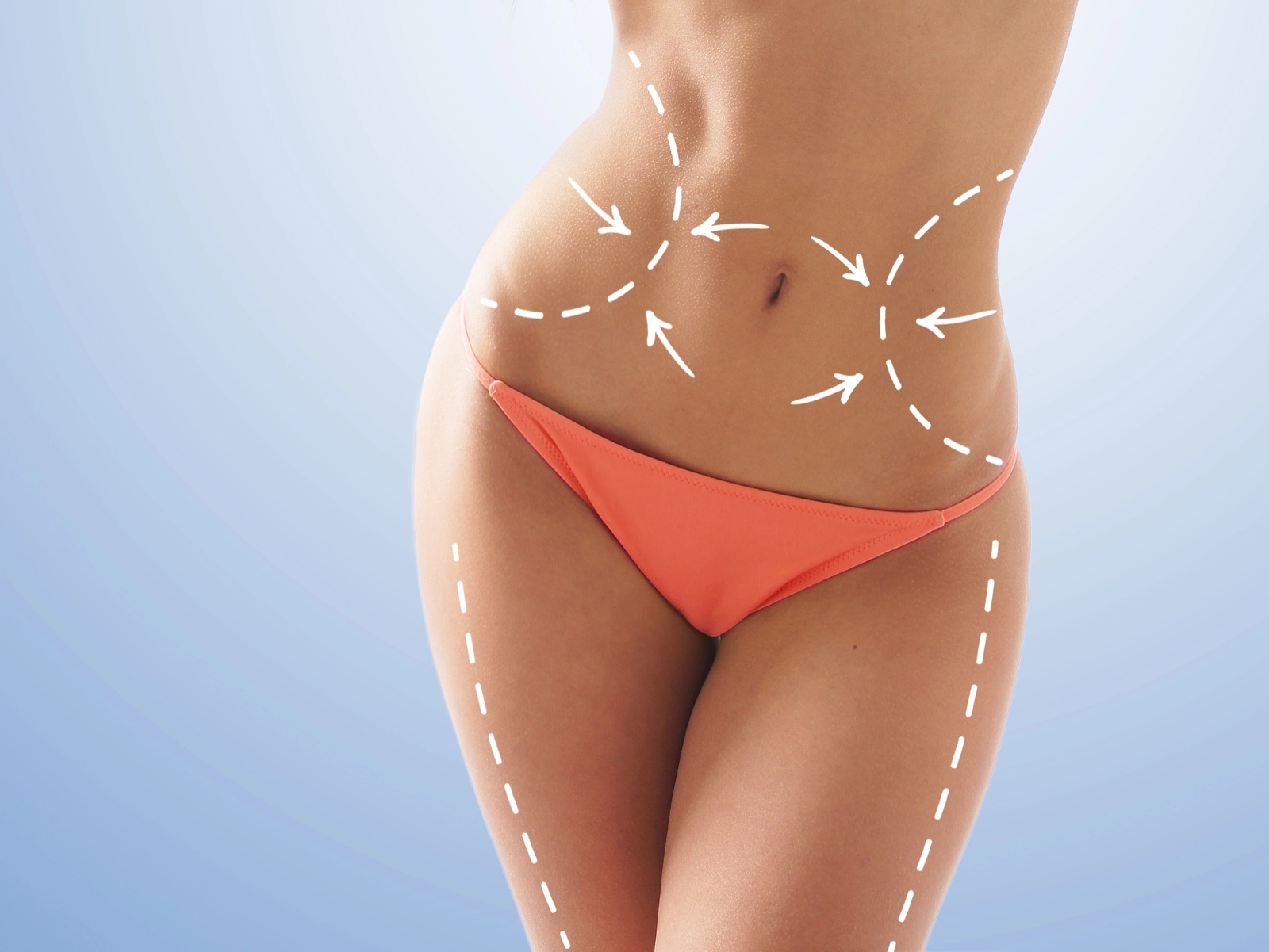 PAL Liposuktion – Fettabsaugung mit OP-Markierung bei Dr. Heitland München
