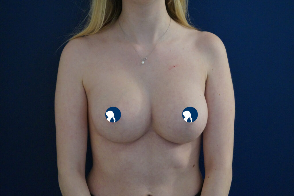 pat-2-re-380-li-265cc-demi-profile-ergonomixs-1