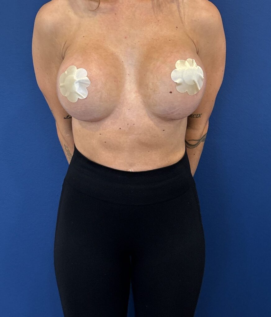 Ergebnis nach Brustvergroesserung bei Dr. Heitland, Muenchen