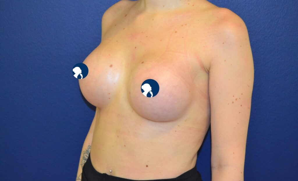 Ergebnis nach Brustvergroesserung bei Dr. Heitland, Muenchen