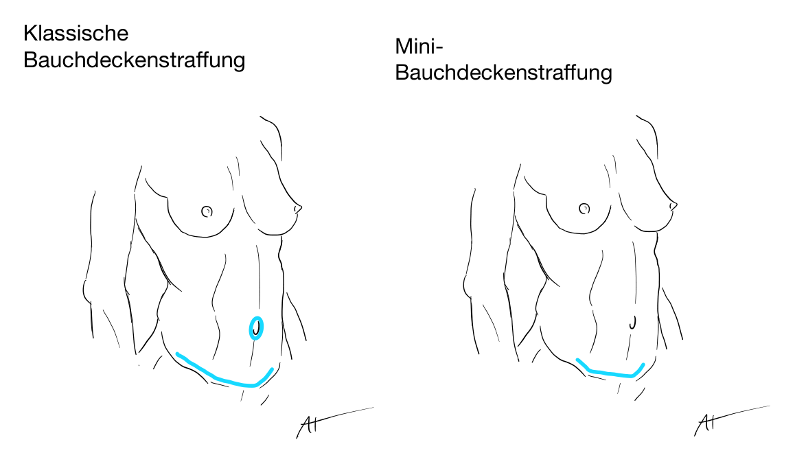 Skizze: Klassische Bauchdeckenstraffung und Mini-Bauchdeckenstraffung im Vergleich