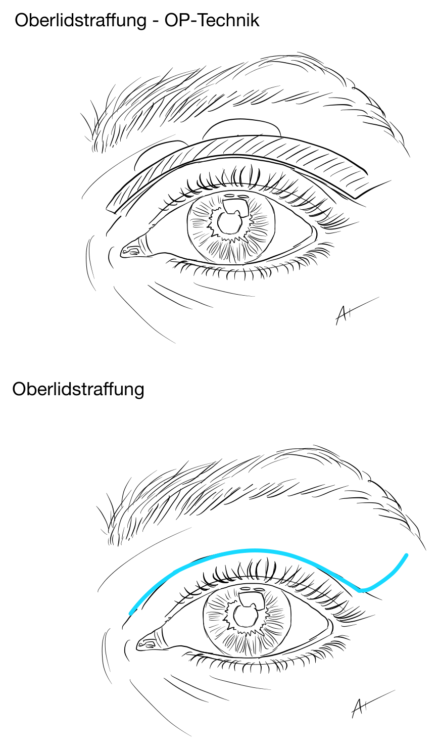 Skizze: Oberlidstraffung – OP-Technik und Schnittführung