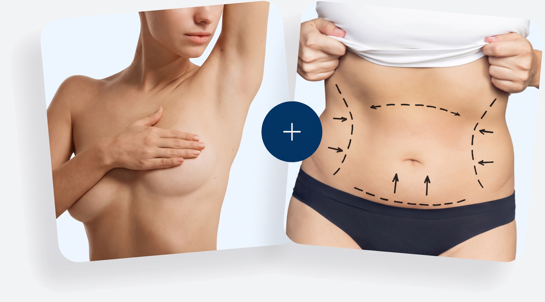 Mommy Makeover – Brust- und Bauchstraffung in einer OP