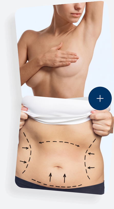 Mommy Makeover – Brust- und Bauchstraffung in einer OP