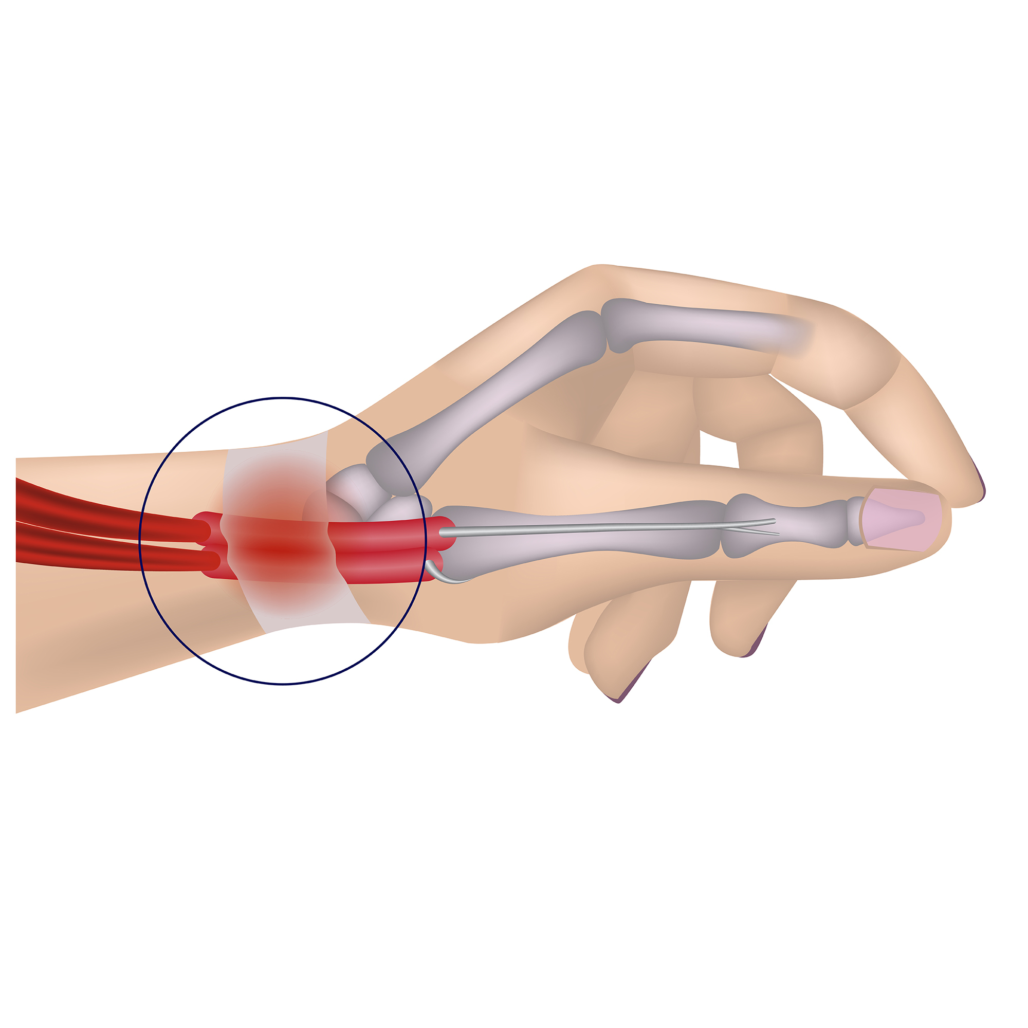 Illustration einer Hand mit rot markiertem, entzündetem Sehnenfach am Handgelenk